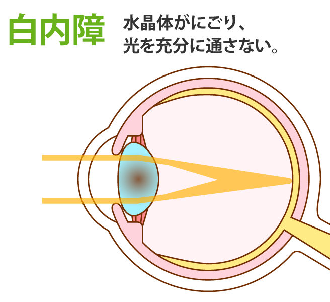 白内障