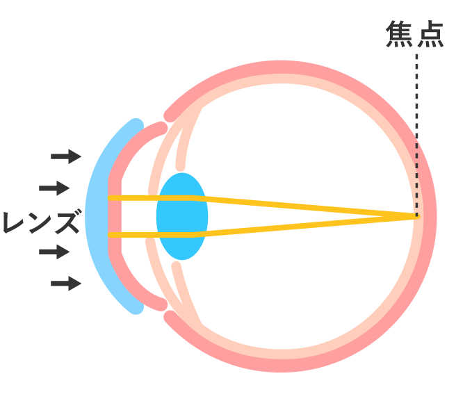 夜：レンズ装用中