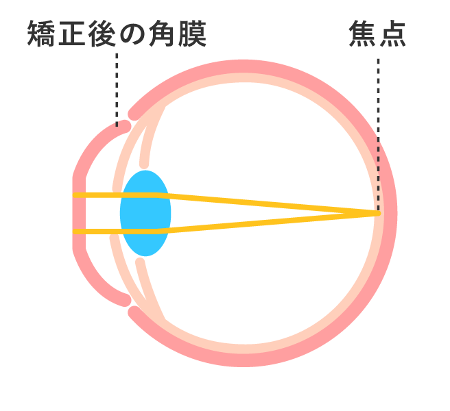 昼：レンズをはずした後