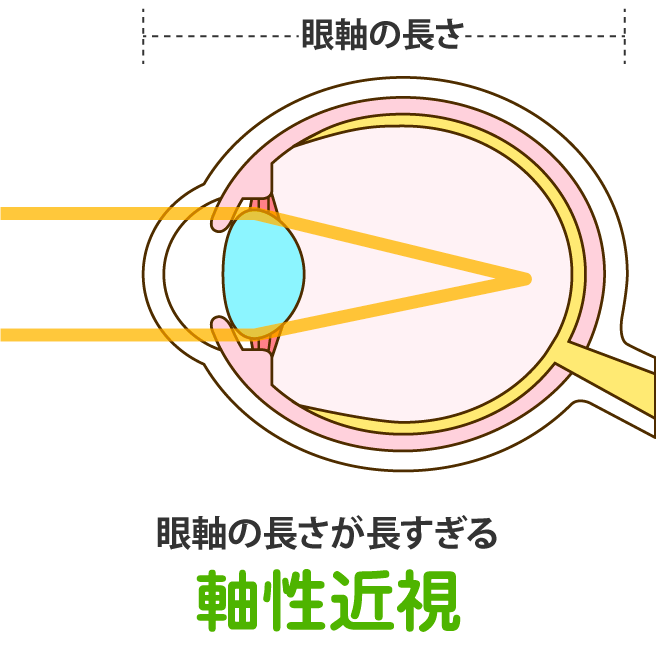 軸性近視