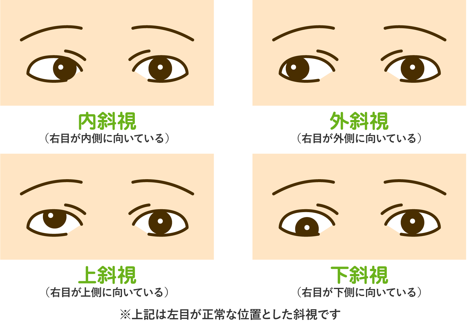 斜視の種類