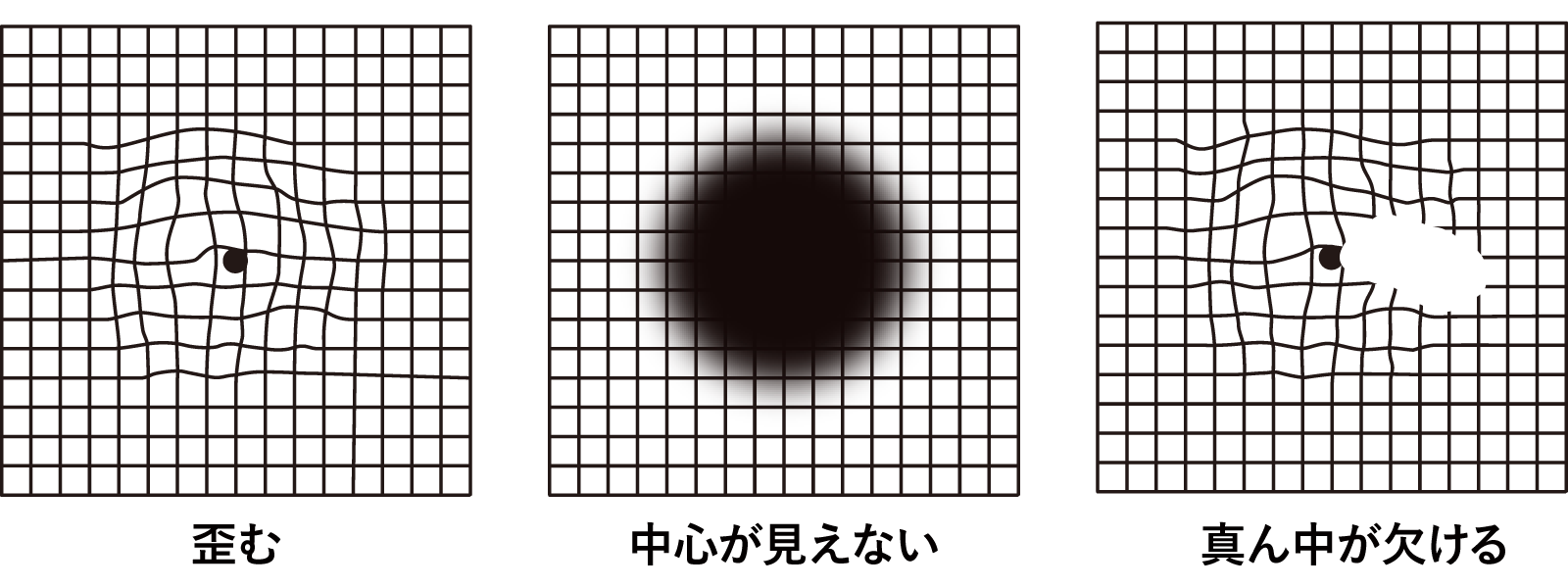 加齢黄斑変性症の見え方